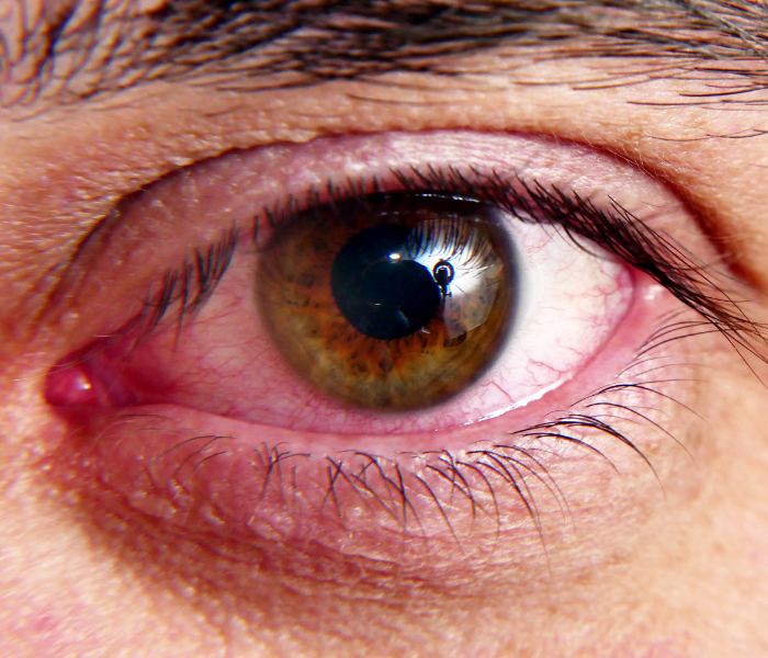 Uveítes - Dra. Camila Amaral